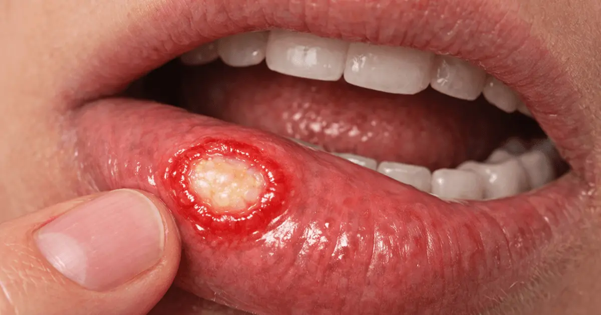 Mouth Ulcer Treatment at Home: Natural Remedies & Practical Steps